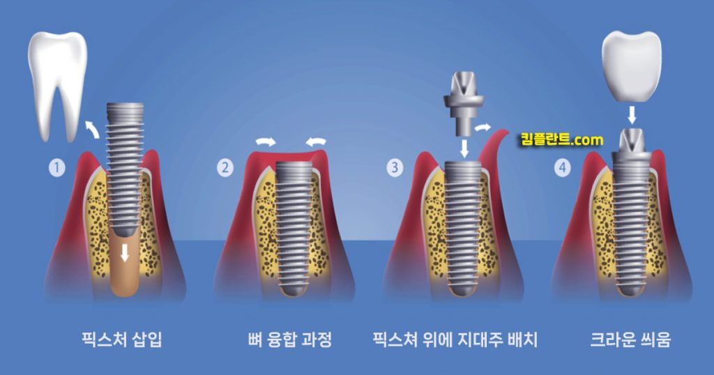 어금니 임플란트 수술 과정 ver2